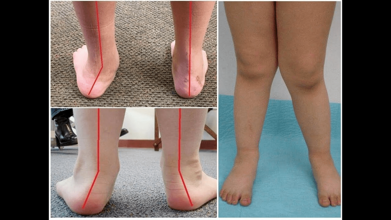 Types of deformations
