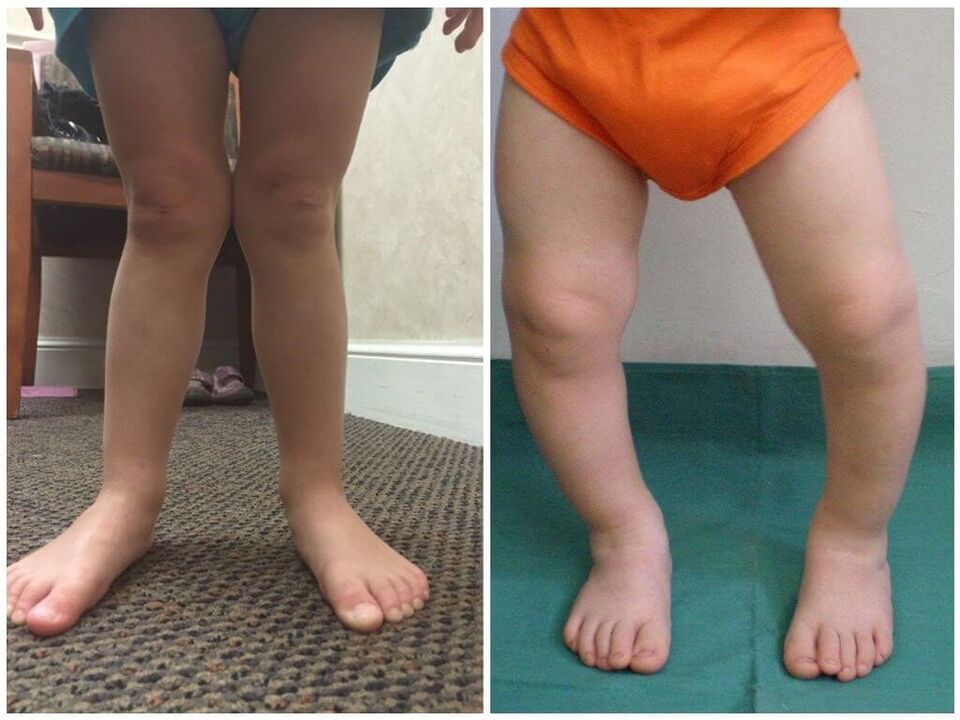 Valgo deformation in children causes