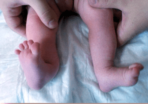 Valgo deformation in children's symptoms