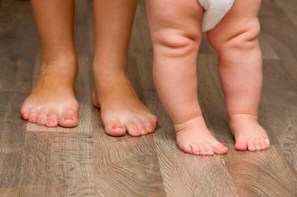 Valgo deformation in children