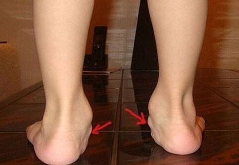 Feet valge deformation in children