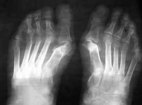 INDICATIONS FOR OPERATIONS UNDER THE FOOT VALGO