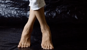 Valgo deformation