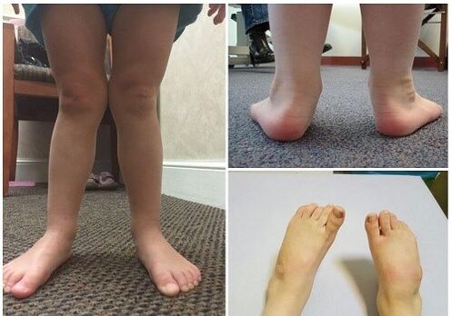 Valgo deformation in children