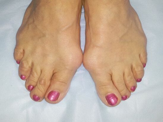 Hallux valgus deformity of the feet