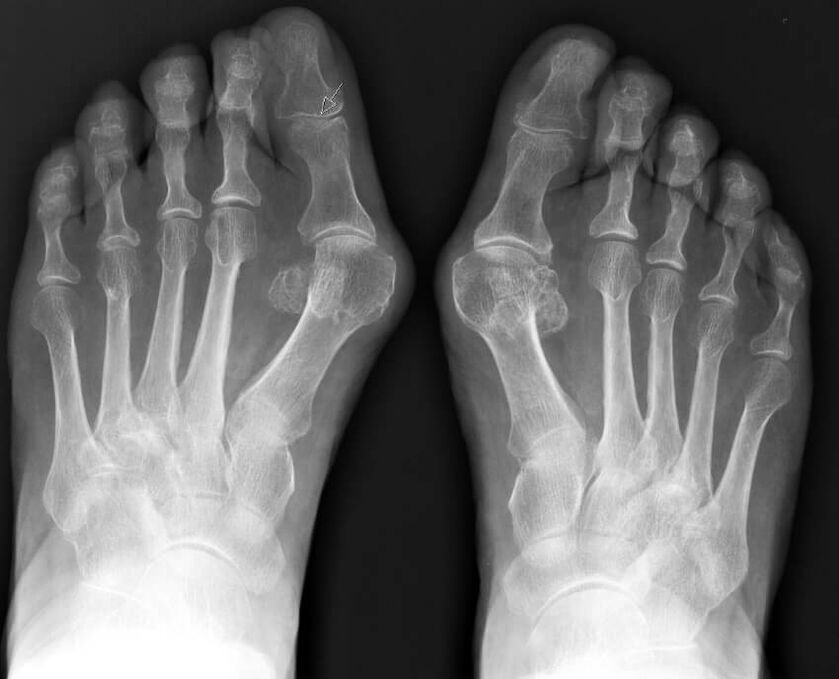 hallux valgus x-ray